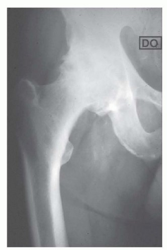 Uncemented THA: Critical Soft Tissue Tension for Joint Stability
