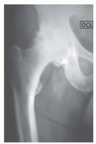 استبدال مفصل الورك بدون أسمنت: استعادة الحركة والثبات في صنعاء مع الأستاذ الدكتور محمد هطيف