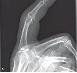 صورة توضيحية لـ التهاب المفاصل التآكلي في مفصل الإصبع السبابة القريب: دليل شامل للعلاج والتعافي مع الأستاذ الدكتور محمد هطيف