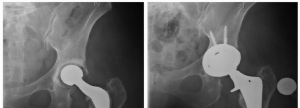 Extended Trochanteric Osteotomy: How et al Extended Revision THA Solutions