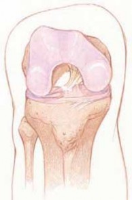 Illustration 70 for Optimizing Single-Bundle Anterior Cruciate Ligament Repair