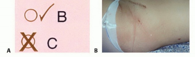 Illustration 42 for Precision Biopsy of Musculoskeletal Tumors for Accurate Diagnosis