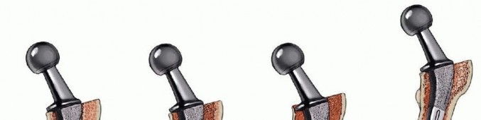 Illustration 2 for Exeter Hip Unit: Mastering Impaction Allografting for Femoral Bone Loss