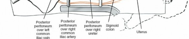 Illustration 21 for Expert Guide: Transperitoneal and Retroperitoneal Lumbar Access