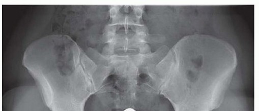 Hip Arthroscopy: Relief for the Athletic and Prearthritic Population