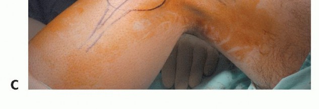 Illustration 8 for Beyond Amputation: The Type I Resection in Fibular Tumor Surgery