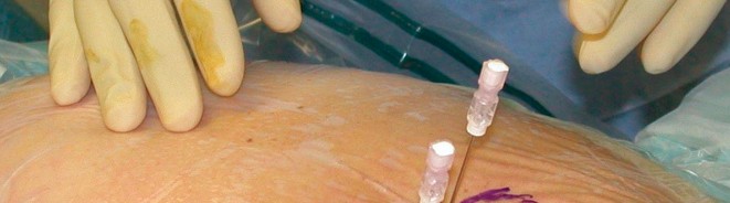 Illustration 16 for Essential Hip Arthroscopy Techniques for Optimal Outcomes