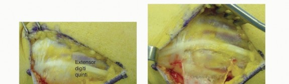 Illustration 13 for Galeazzi DRUJ Stabilization: Unlocking Stability with Smooth Stainless Steel