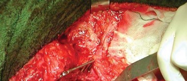 Illustration 23 for Expert Bone Grafting for Primary Total Hip Replacement Success