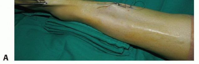 Illustration 34 for Foot Drop Surgery: How a Pin or Drill Elevates Tendon Transfer