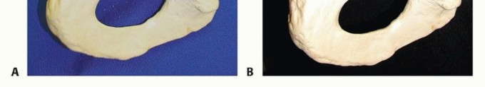 Illustration 15 for Pelvic Discontinuity: Understanding Superior and Inferior Separation