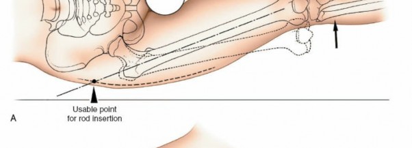 Illustration 61 for Optimal Femoral Approaches: Mastering the Lateral Intermuscular Septum