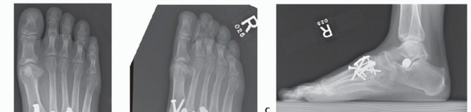 Illustration 38 for Mastering Midfoot Arthrodesis: Protect the Deep Neurovascular Bundle