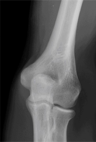 Illustration 4 for Elbow Dislocation Cases: Diagnose, Treat & Manage Effectively
