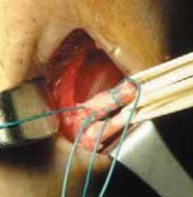 Illustration 12 for Optimizing Single-Bundle Anterior Cruciate Ligament Repair