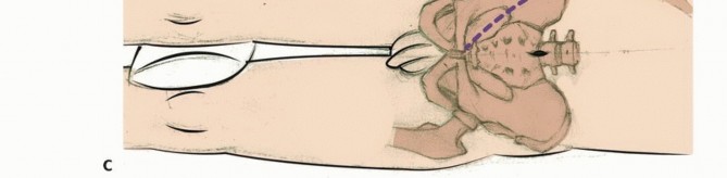 Illustration 25 for Sacral Tumor Surgery: Safeguarding Bowel & Bladder Control