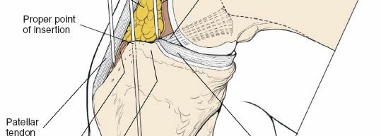 Illustration 127 for Surgical Access: Mastering the Tibia's Surface & Fibula Approaches