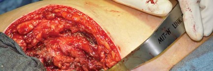 Illustration 69 for Collum Femoris Preserving: Achieve Better Primary Hip Outcomes