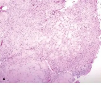 الورم الليفي الغضروفي المخاطي: دليل شامل للمرضى مع الأستاذ الدكتور محمد هطيف