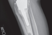 Illustration 24 for Porous Metal Cones: Biologic Fixation for Severe Bone Loss