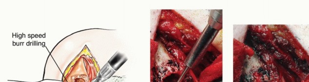 Illustration 17 for Restore Vital Function: Surgery for Type II Humeral Metastasis