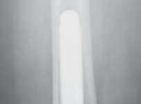 Illustration 68 for Mastering Gap Balancing in Revision TKA: Avoid Common Pitfalls