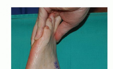 Illustration 22 for Foot Drop Surgery: How a Pin or Drill Elevates Tendon Transfer