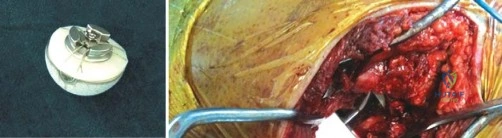 Illustration of metal on metal - Dr. Mohammed Hutaif