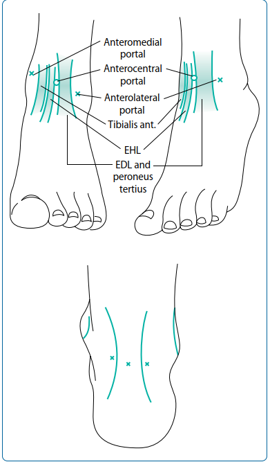 Mastering Foot & Ankle Interventions: Essential Ankle Surgery Insights