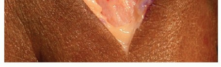 Illustration 6 for MTP Joint Arthrodesis: The Key to Optimal Toe Positioning