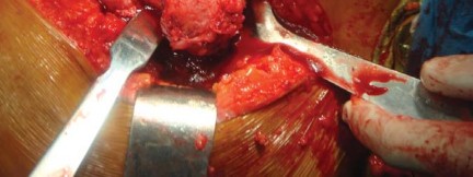 Illustration 14 for The Silent Hip: Achieving a Truly Silent, Pain-Free Joint