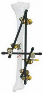 Achieve Optimal Results: Femoral Shaft Reduction & External Fixation