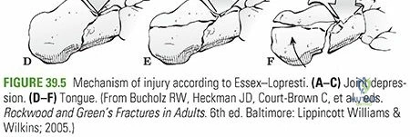 Illustration of calcaneus fractures calcaneus - Dr. Mohammed Hutaif