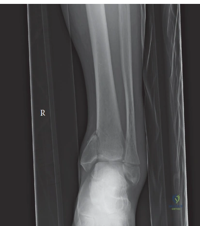 Illustration of case ankle fracture - Dr. Mohammed Hutaif