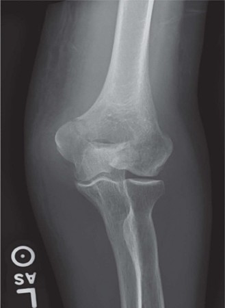 Mastering Distal Humerus Fractures: Diagnosis & Treatment
