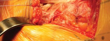 Illustration 60 for Successful Total Hip Replacement in Developmental Dysplasia