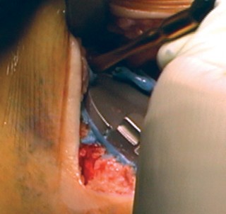 Illustration 34 for Cemented TKA Figure: Your Visual Guide to Surgical Success