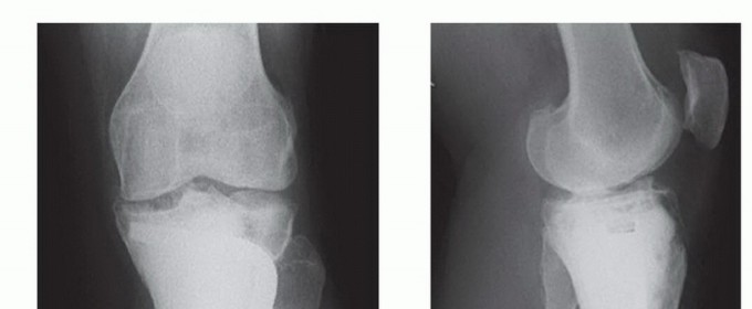 Illustration 30 for Avoid Major Surgery: Bone Tumor Treatment with Liquid Nitrogen Pour