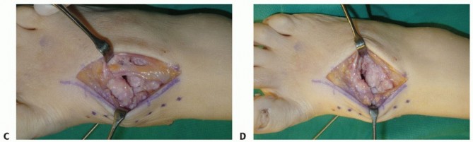 Illustration 46 for Mastering Midfoot Arthrodesis: Protect the Deep Neurovascular Bundle