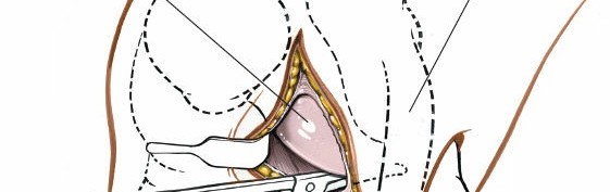 Illustration 59 for Mastering Knee Approaches: Spotlight on Superficial Medial Ligament