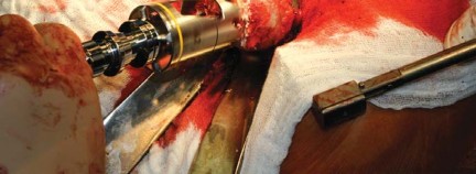 Illustration 58 for Metal on Metal Resurfacing: Enhanced Posterior Soft Tissue Repair