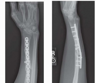 Corrective Osteotomy for Radius: End Pain, Restore Function