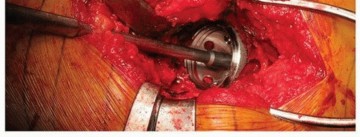 Illustration 27 for Uncemented Acetabular Revision: Optimizing Hemispherical Cup Use