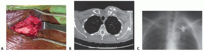 Illustration 22 for Optimizing SC Dislocation Repair After Medial Clavicle Resection