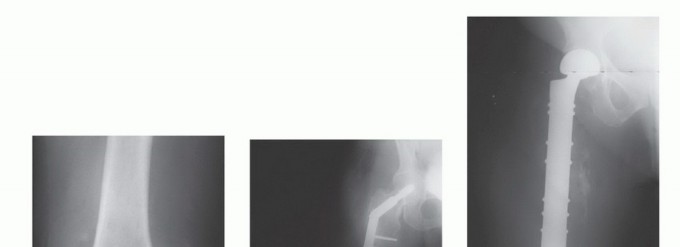 Illustration 6 for Plain Radiograph Showing MBD: Surgical Planning to Prevent Failures