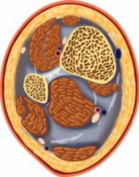 Illustration 25 for Optimizing ORIF for Tibial Plafond Fractures: A Modern Approach