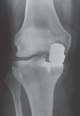 Illustration 3 for Oral Examination Question: Master Unicondylar UKA vs HTO