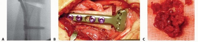 Illustration 24 for Precision Correction for Distal Radius Malunion