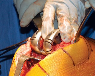 Illustration 41 for Mastering Gap Balancing in Revision TKA: Avoid Common Pitfalls