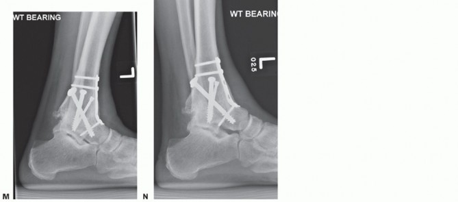 Illustration 26 for Optimize Pain Management with Proximal Ring Block for Ankle Arthrodesis